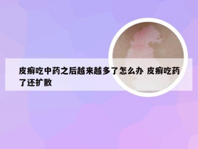 皮癣吃中药之后越来越多了怎么办 皮癣吃药了还扩散