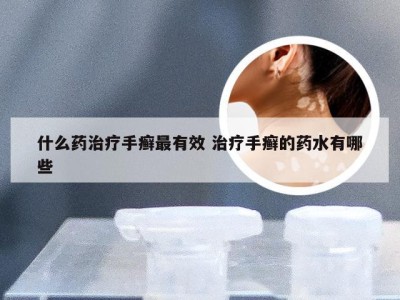 什么药治疗手癣最有效 治疗手癣的药水有哪些