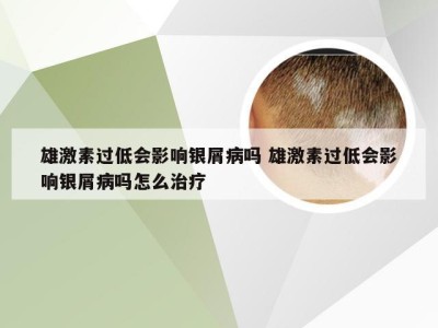 雄激素过低会影响银屑病吗 雄激素过低会影响银屑病吗怎么治疗