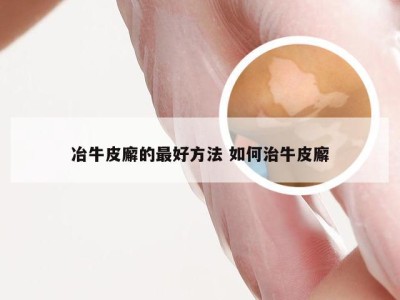 冶牛皮廨的最好方法 如何治牛皮廨