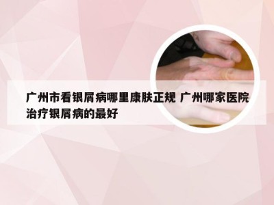 广州市看银屑病哪里康肤正规 广州哪家医院治疗银屑病的最好