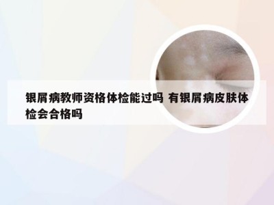 银屑病教师资格体检能过吗 有银屑病皮肤体检会合格吗