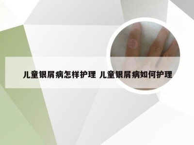 儿童银屑病怎样护理 儿童银屑病如何护理