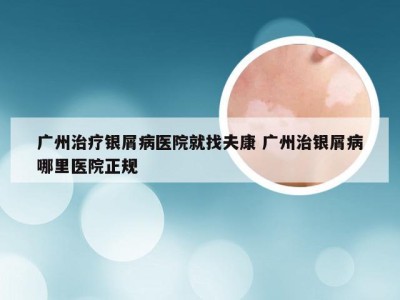 广州治疗银屑病医院就找夫康 广州治银屑病哪里医院正规