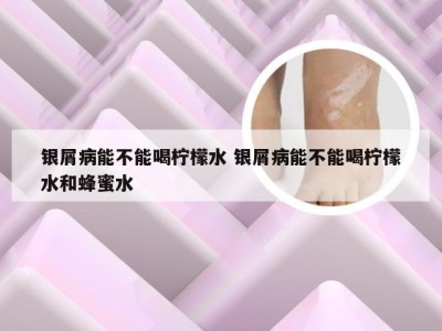 银屑病能不能喝柠檬水 银屑病能不能喝柠檬水和蜂蜜水