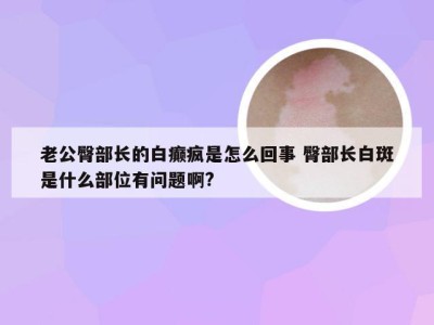 老公臀部长的白癫疯是怎么回事 臀部长白斑是什么部位有问题啊?