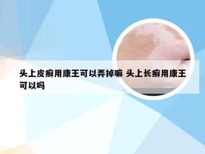 头上皮癣用康王可以弄掉嘛 头上长癣用康王可以吗