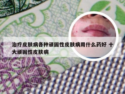 治疗皮肤病各种顽固性皮肤病用什么药好 十大顽固性皮肤病