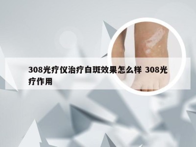 308光疗仪治疗白斑效果怎么样 308光疗作用