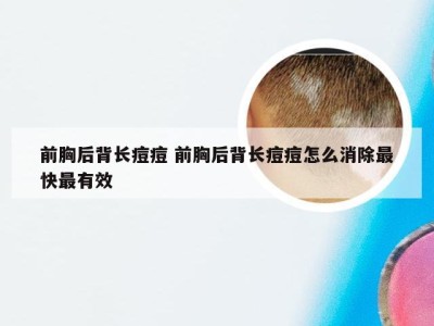 前胸后背长痘痘 前胸后背长痘痘怎么消除最快最有效