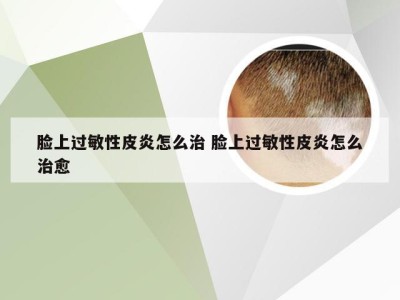 脸上过敏性皮炎怎么治 脸上过敏性皮炎怎么治愈