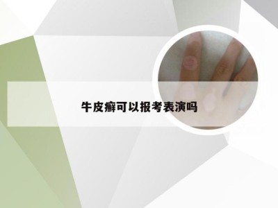 牛皮癣可以报考表演吗