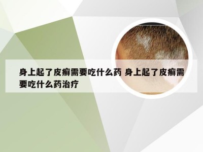 身上起了皮癣需要吃什么药 身上起了皮癣需要吃什么药治疗