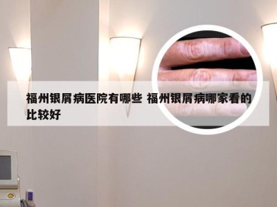 福州银屑病医院有哪些 福州银屑病哪家看的比较好