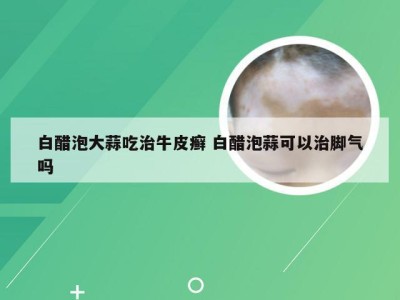 白醋泡大蒜吃治牛皮癣 白醋泡蒜可以治脚气吗