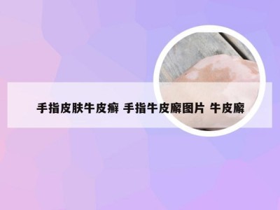 手指皮肤牛皮癣 手指牛皮廨图片 牛皮廨