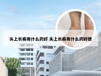 头上长癣用什么药好 头上长癣用什么药好使