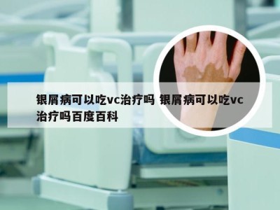 银屑病可以吃vc治疗吗 银屑病可以吃vc治疗吗百度百科