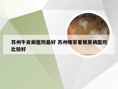 苏州牛皮癣医院最好 苏州哪家看银屑病医院比较好