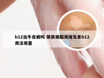 b12治牛皮癣吗 银屑病服用维生素b12用法用量