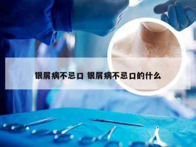 银屑病不忌口 银屑病不忌口的什么