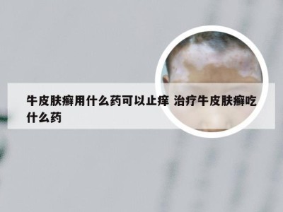 牛皮肤癣用什么药可以止痒 治疗牛皮肤癣吃什么药