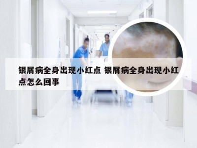 银屑病全身出现小红点 银屑病全身出现小红点怎么回事