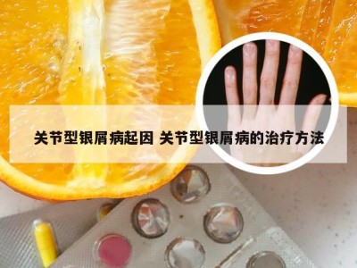 关节型银屑病起因 关节型银屑病的治疗方法