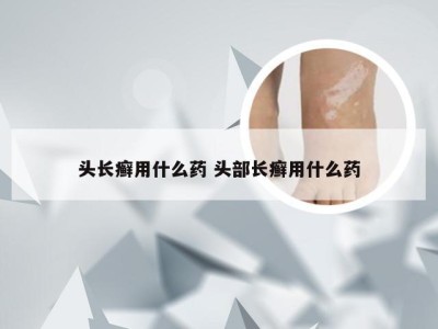 头长癣用什么药 头部长癣用什么药