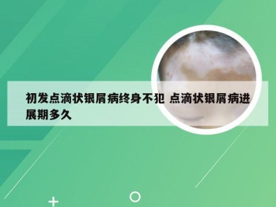 初发点滴状银屑病终身不犯 点滴状银屑病进展期多久