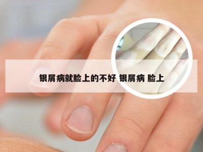 银屑病就脸上的不好 银屑病 脸上