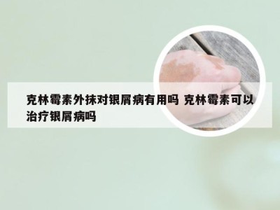 克林霉素外抹对银屑病有用吗 克林霉素可以治疗银屑病吗