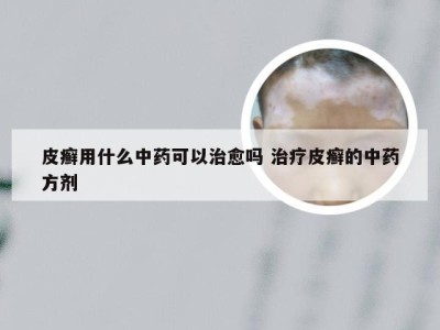 皮癣用什么中药可以治愈吗 治疗皮癣的中药方剂