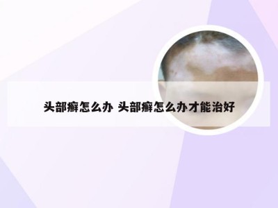 头部癣怎么办 头部癣怎么办才能治好