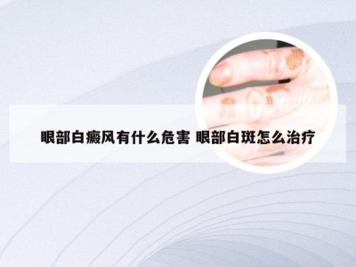 眼部白癜风有什么危害 眼部白斑怎么治疗