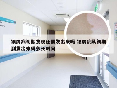 银屑病初期发现还要发出来吗 银屑病从初期到发出来得多长时间