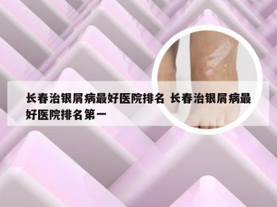 长春治银屑病最好医院排名 长春治银屑病最好医院排名第一