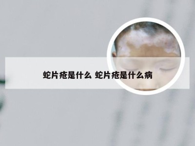 蛇片疮是什么 蛇片疮是什么病