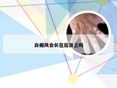 白癜风会长在后背上吗