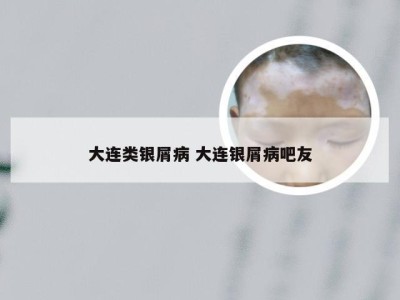 大连类银屑病 大连银屑病吧友