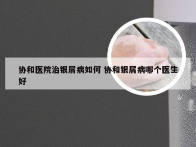 协和医院治银屑病如何 协和银屑病哪个医生好