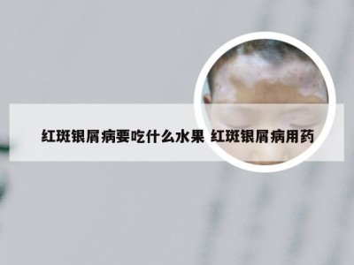 红斑银屑病要吃什么水果 红斑银屑病用药