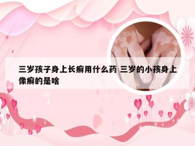 三岁孩子身上长癣用什么药 三岁的小孩身上像癣的是啥