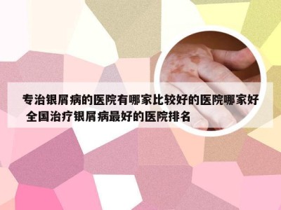 专治银屑病的医院有哪家比较好的医院哪家好 全国治疗银屑病最好的医院排名