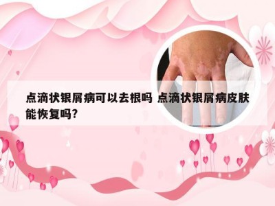 点滴状银屑病可以去根吗 点滴状银屑病皮肤能恢复吗?