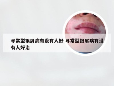 寻常型银屑病有没有人好 寻常型银屑病有没有人好治