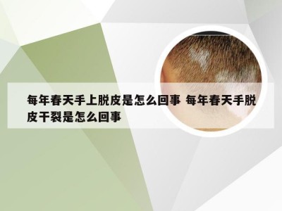 每年春天手上脱皮是怎么回事 每年春天手脱皮干裂是怎么回事