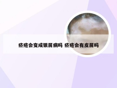 疥疮会变成银屑病吗 疥疮会有皮屑吗