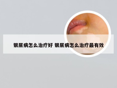 银屑病怎么治疗好 银屑病怎么治疗最有效