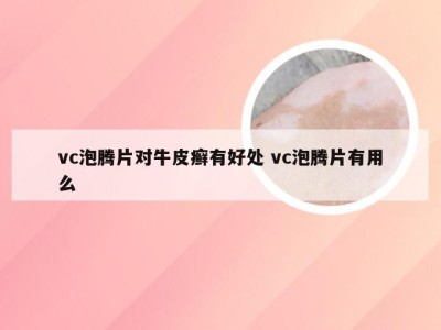 vc泡腾片对牛皮癣有好处 vc泡腾片有用么